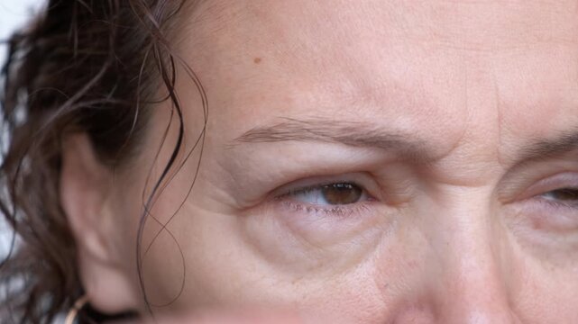 Allergy to the eyes. Close-up of a woman's face with puffy eyes from allergies.