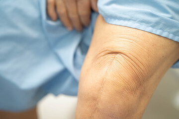 Obraz premium Asian elderly woman patient with scar knee replacement surgery in hospital.