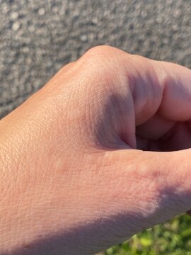 bolle da orticaria