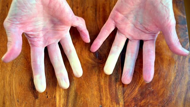 Close-up of two adult hands with Raynaud's syndrome  