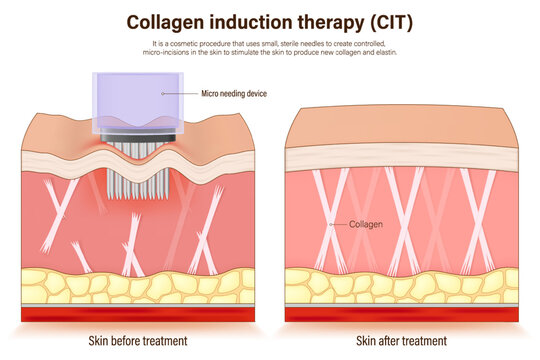 Collagen induction therapy. Microneedling. A cosmetic procedure that uses small needles. Vector for advertising about beauty and medical treatment.