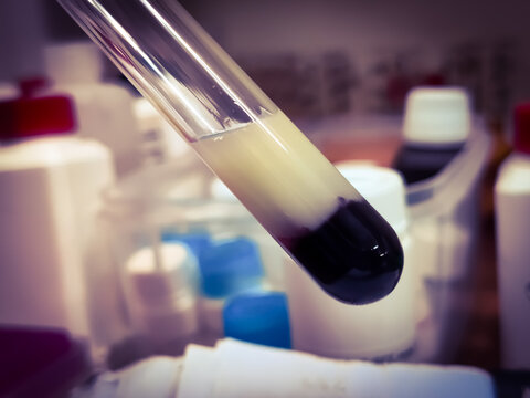 Lipemic serum in glass test tube. It's a blood sample that is cloudy or milky due to an excess of fats (lipoproteins and triglycerides).