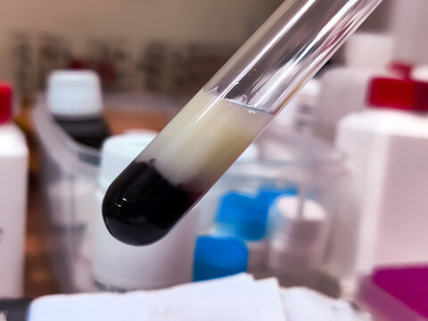 Lipemic serum in glass test tube. It's a blood sample that is cloudy or milky due to an excess of fats (lipoproteins and triglycerides).