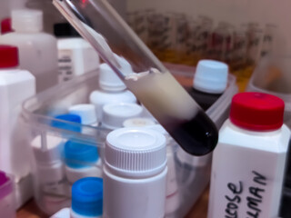 Lipemic serum in glass test tube. It's a blood sample that is cloudy or milky due to an excess of fats (lipoproteins and triglycerides).