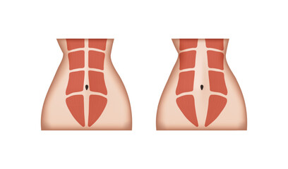 Diastasis recti, normal abdominal muscles and separated abdominal muscles