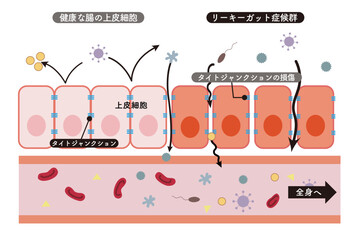 リーキーガット症候群をわかりやすく表した小腸上皮細胞の断面図