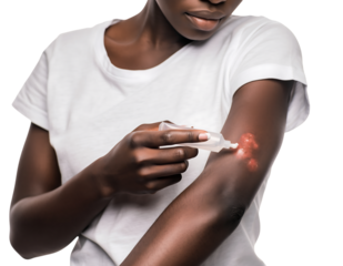 Woman applying ointment to burn wound on arm isolated on transparent background