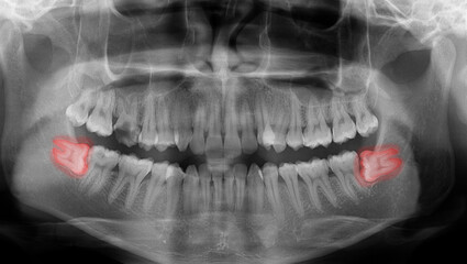 Xray of teeth dental panoramic radiograph shows full teeth and impacted wisdom teeth.