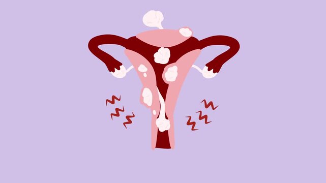 Anatomy Illustration of Uterine Fibroid in the Womb