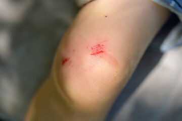 Child knee with scraped wound