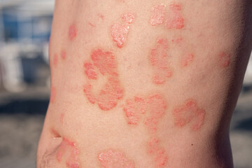 Naklejka premium Skin Affected by Psoriasis Displaying Red Patches on the Body Under Natural Sunlight at a Beach Location