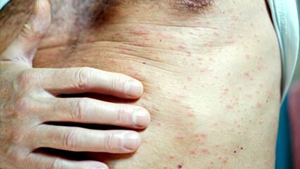 Man experiencing an uncomfortable irritating skin rash on his body, a visible symptom of a skin...