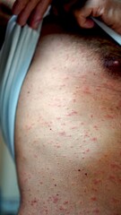 Fototapeta premium Man is lifting his shirt, revealing his torso covered with a reddish widespread skin rash, possibly shingles, indicating a skin condition or illness
