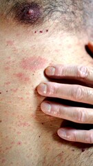 Obraz premium Human chest and abdomen with skin presenting a rash and irritation, a person's hand touching the affected area, illustrating concepts of dermatology, illness, and health issues