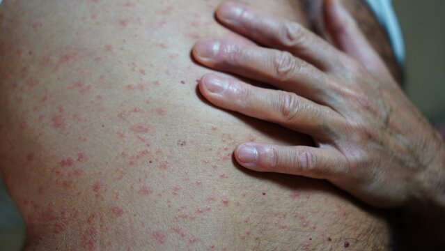 Person's upper body experiencing a widespread allergic skin rash, showing redness and potential irritation, indicating a dermatological condition possibly related to stress or internal issues