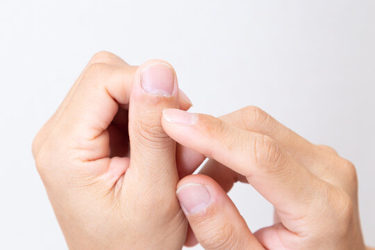 指のささくれ　白バック