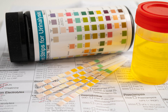 Urinalysis, urine cup with reagent strip pH paper test and comparison chart in laboratory.