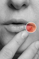 A person points at a lesion on their lip caused by the herpes virus. The image highlights the need for proper treatment and ways to strengthen immunity against future outbreaks.