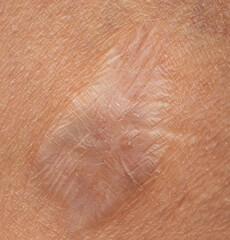 Fototapeta premium scar on the skin of the leg as a background.