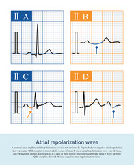Atrial repolarization wave is the ECG wave of atrial repolarization, and its polarity is opposite to that of sinus P wave in the same lead, so it is usually not easy to observe from ECG.
