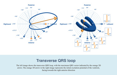The projection of the transverse QRS loop forms chest leads, and from lead V1 to lead V6, the QRS wave gradually evolves from rS wave to qRs wave.
