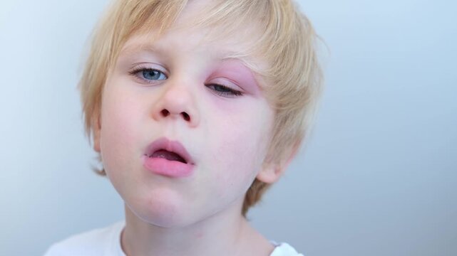 close up little boy with allergic red spot at face cause by mosquito bite