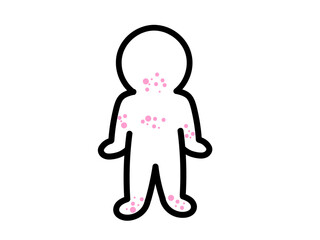 発疹がでる　ストレス