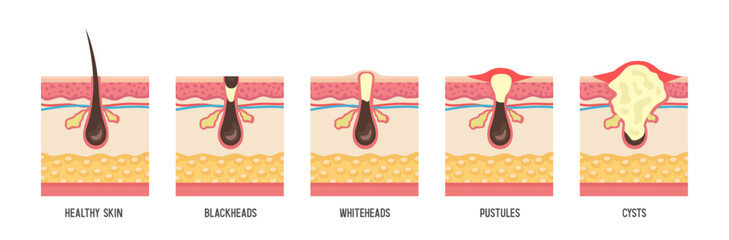 Human skin structure. Acne types. Vector flat illustration isolated on white background.