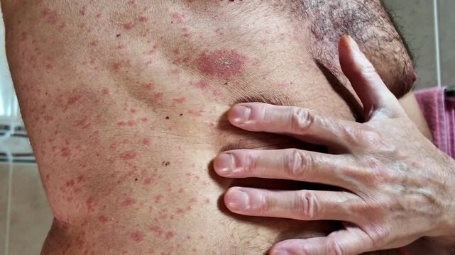 Close-up of an adult man with a severe allergic reaction or viral infection, showing red spots, hives, and itchy skin on his chest and torso, representing a dermatological condition