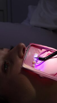 Close-up of dentist curing composite filling with UV light. Polymerization process, cavity treatment, dental restoration, modern dentistry, oral care.