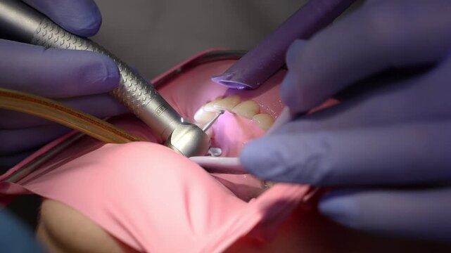 Close-up of dentist removing tooth decay with a dental drill on front teeth. Rubber dam isolation, professional cavity treatment, modern dentistry procedure and oral care.