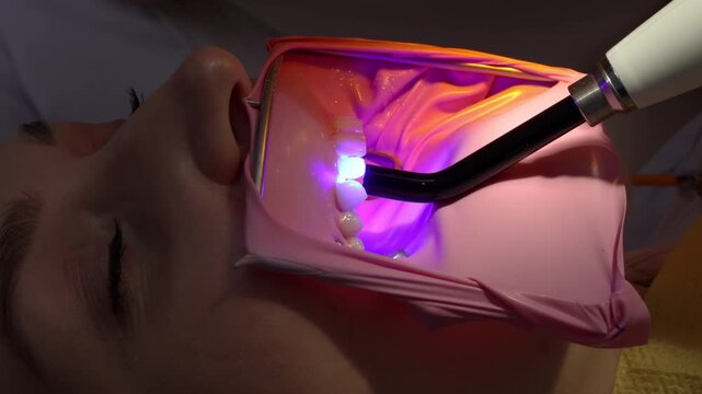 Close-up of dentist curing composite filling with UV light. Polymerization process, cavity treatment, dental restoration, modern dentistry, oral care.