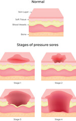 Stages of Pressure Sores Vector Illustration