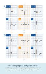 The research progress of Epsilon suggests that the Epsilon wave can appear in any part of the QRS complex, including the beginning, middle, and end.

