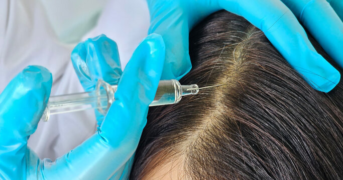 Close-Up of Hair Loss Treatment Injection Administered by Medical Professional