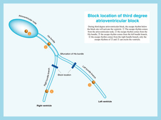 Third degree atrioventricular block can occur in the atrioventricular node, His bundle, and bundle branches, and only the escape rhythm from below the block layer can excite the ventricle.
