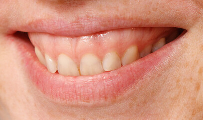 Obraz premium A woman's teeth are visible in a close up
