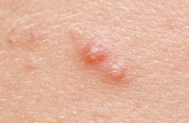 Fototapeta premium A red bump on a person's arm. The bump is yellow and has a white center. It is a pimple.