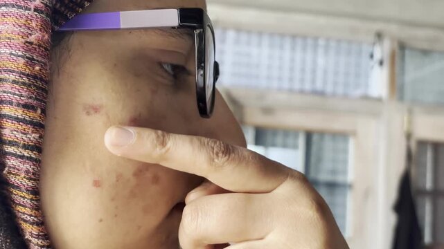Women's skin 20-30 years old, pigmented dark spots on the face, enlarged pores. Care and cosmetology. Simple close-up video. A young girl's face with pimples dark spots and large pores itching.