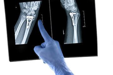 Hand finger in glove points X-ray of hand surgical options for treating a distal radius fracture Inserting a purpose-built orthopaedic plate with open reduction internal fixation frontal lateral view