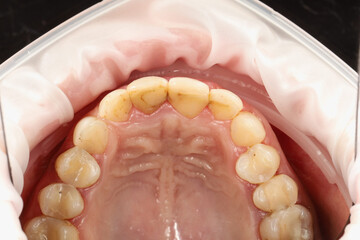 Obraz premium Upper oral cavity with teeth, gums, and palate clearly visible, using a cheek retractor during a dental procedure for hygiene or restorative dentistry