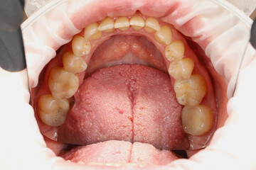 Dentist performing an oral examination, showing the patient's open mouth with a view of the upper dental arch and tongue, for dental hygiene and health concept