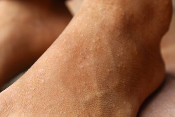 Close up of the surface of the skin on the feet which looks dry with a smooth texture and small spots 