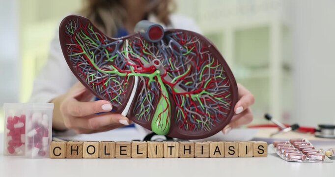 Wooden blocks spell word Cholelithiasis near liver with gallbladder model. Woman doctor shows anatomic model planing treatment for cholelithiasis