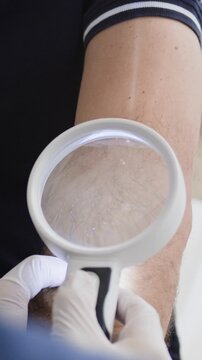 Vertical cropped shot of hands of unrecognizable doctor in white sterile gloves examining patients inner elbow through magnifying glass during dermatology consultation in clinic