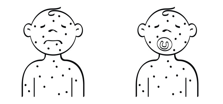 Skin rash, measles on young child and baby face. Rash on the body. A sign of measles, lupus, herpes, or rubela, and other autoimmune diseases. Rubeola or morbilli symptom. food allergy. Itchy skin.