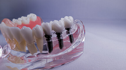 External view of a mandibular dental model showing integrated dental implant fixtures from the...