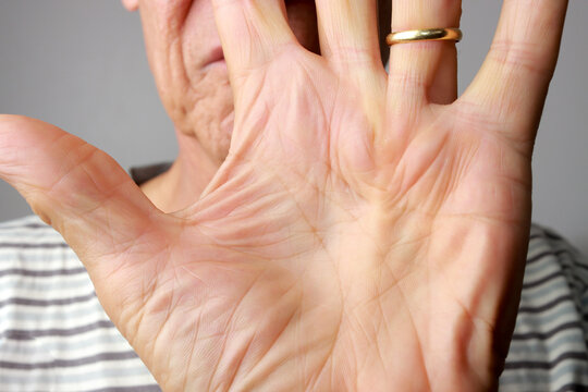 Senior Man Demonstrating his Dupuytren Contracture on the palm of his hand