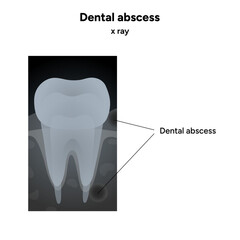 X-ray view of tooth with dental abscess. Illustration highlights the infected root area, bone loss, inflammation, and periapical infection visible on the radiograph