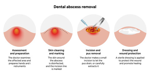Hand-drawn dental illustration showing process of dental abscess removal, including infected tooth, drainage, and cleaning stages